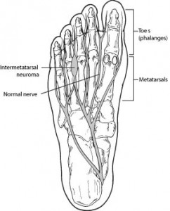 Intermetatarsal Neuroma